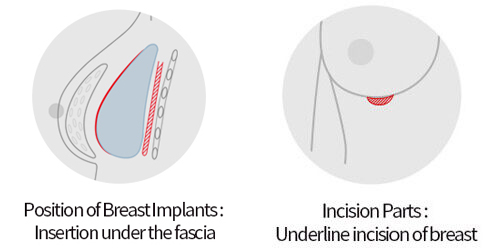 Insertion under the fascia