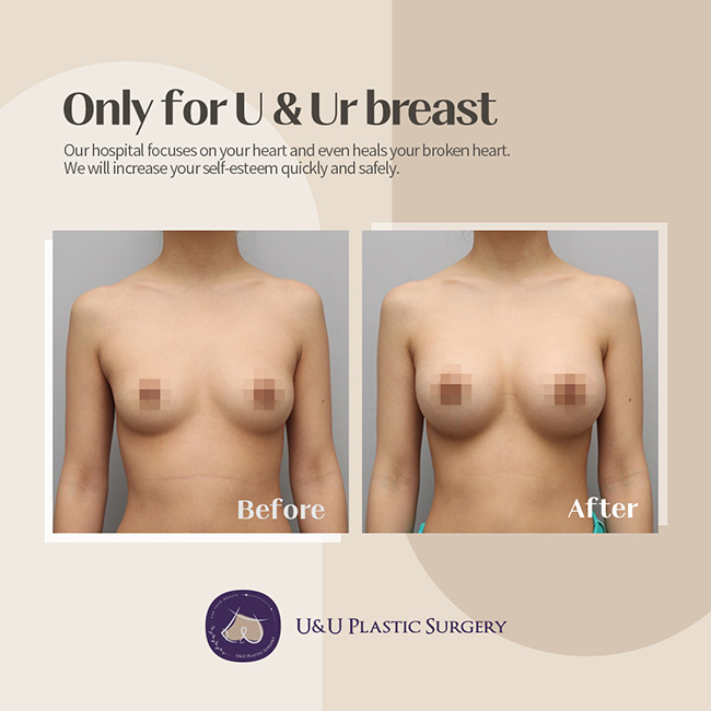 NATURAL-BREAST-AUGMENTATION-PROCEDURE