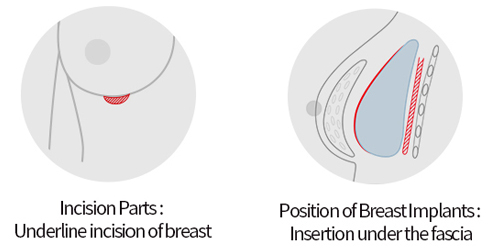 breast-surgery