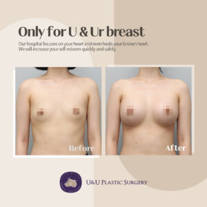 breast surgery after breastfeeding